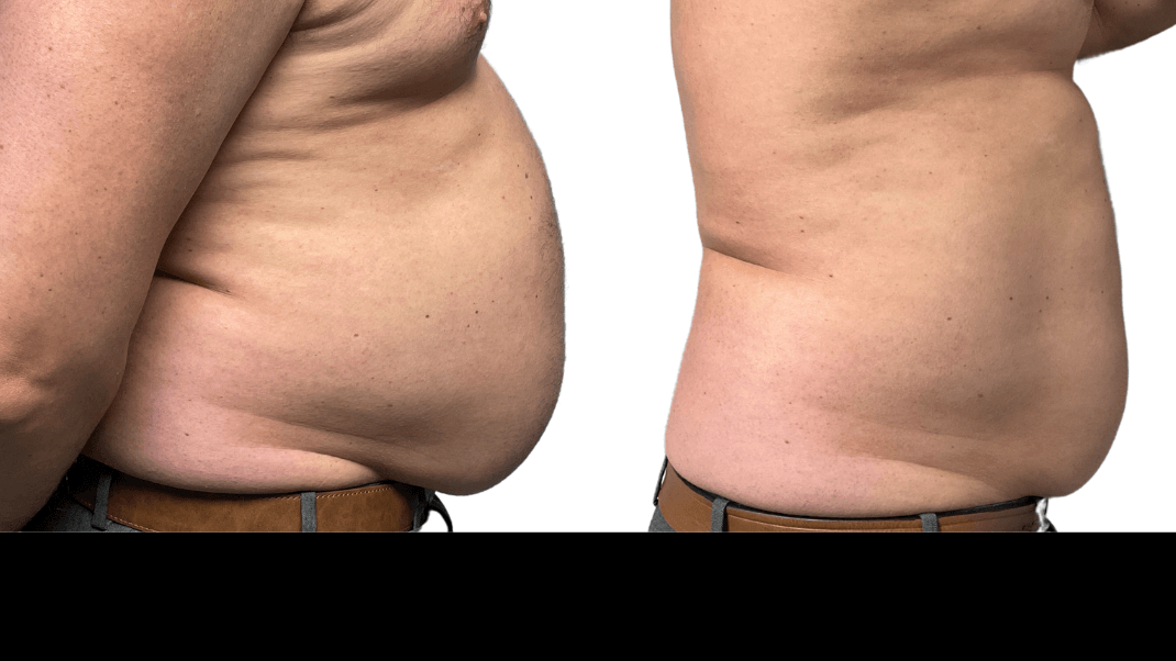 Before and after